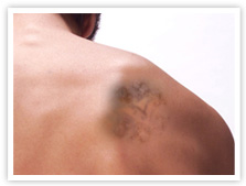 刺青治療の限界と合併症について