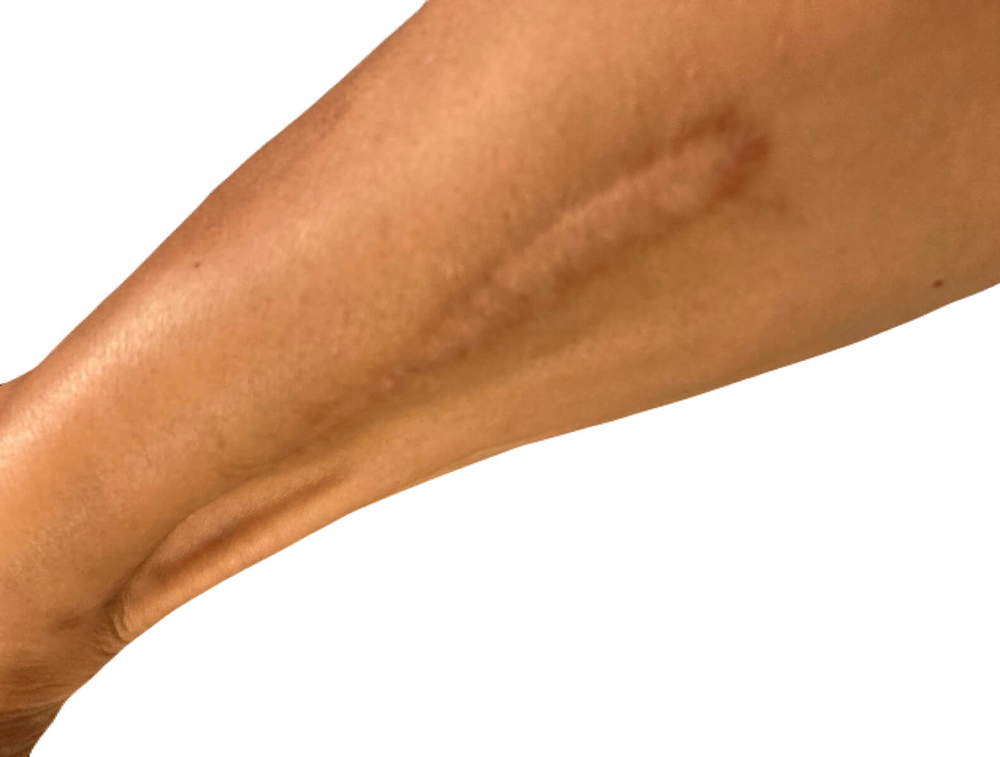 レーザー治療で対応できる傷跡の種類と適した治療法